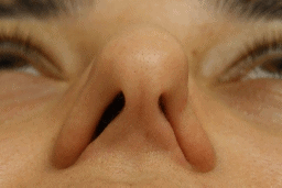 Der Nasenklappenkollaps